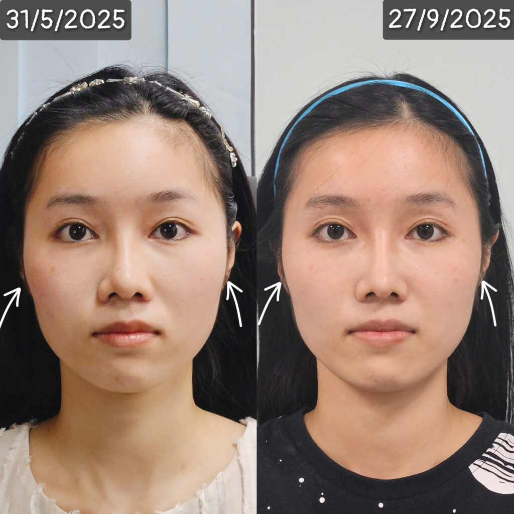 bonart face tại dr.Tan clinic