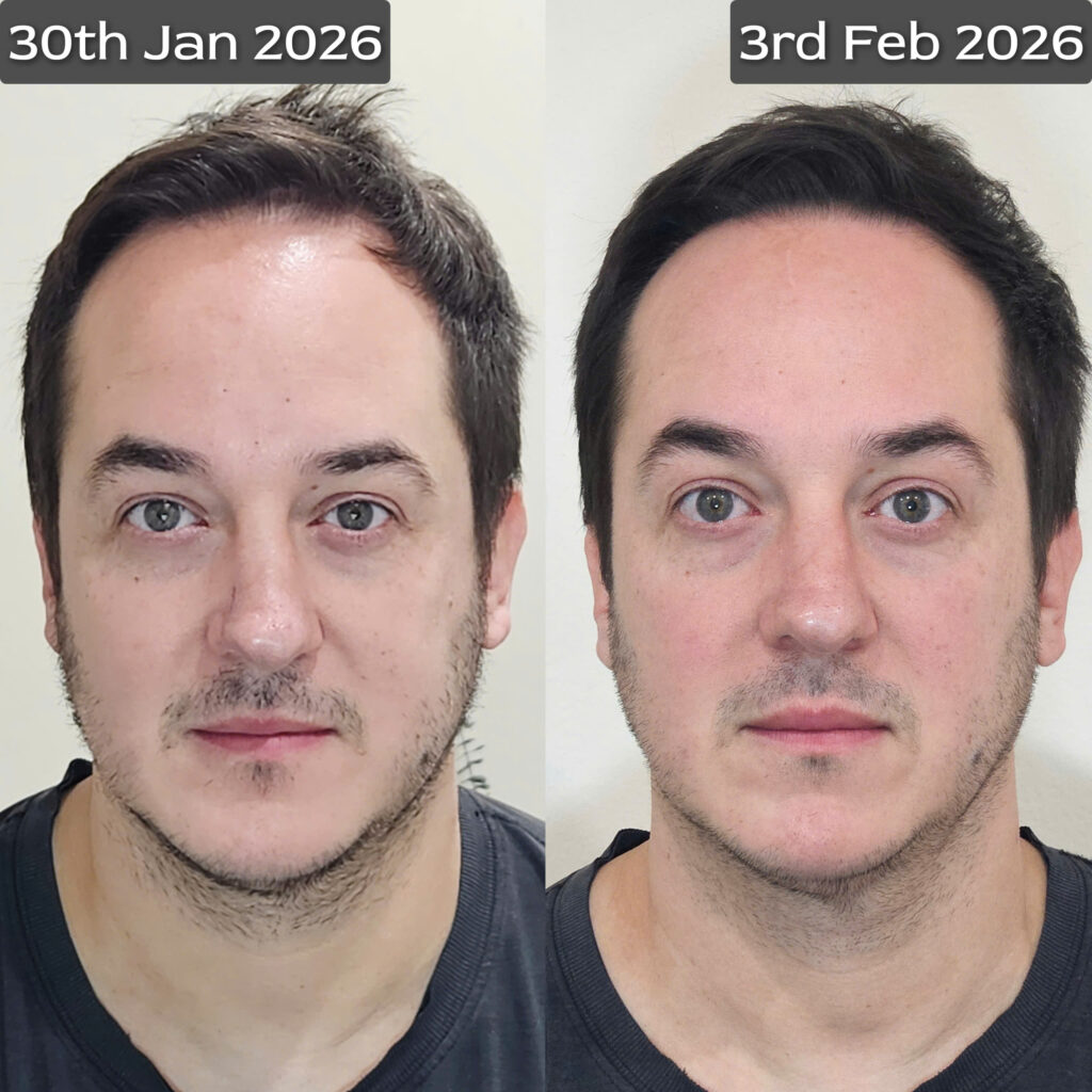 Bonart Face nắn chỉnh trị liệu đau đầu và lệch sóng mũi