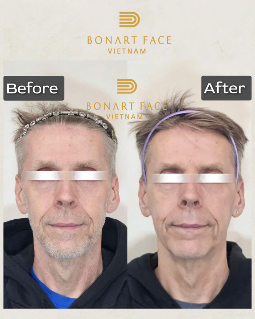 Bonart Face tại Dr. Tan Clinic: Khi nắn chỉnh mặt đánh bay cơn đau nửa đầu lâu năm