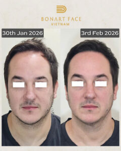 Review khách hàng chữa chóng mặt ù tai lâu năm bằng Bonart Face tại Dr. Tan clinic