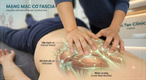 Cân chỉnh mạc cơ tại Dr Tanclinic